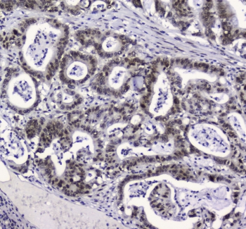 IHC testing of FFPE human intestinal cancer with APE1 antibody at 2ug/ml. HIER: boil tissue sections in pH6, 10mM citrate buffer, for 10-20 min followed by cooling at RT for 20 min.