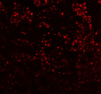 Immunofluorescent staining of FFPE human breast cancer tissue with DIS3 antibody (red). HIER: steam section in pH8 EDTA buffer for 20 min.