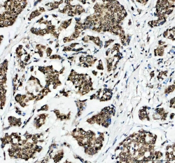 IHC staining of FFPE human breast cancer tissue with Histone H2AX antibody. HIER: boil tissue sections in pH8 EDTA for 20 min and allow to cool before testing.