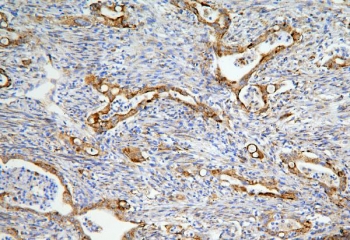 IHC staining of FFPE human rectal cancer with LONP1 antibody. HIER: boil tissue sections in pH6, 10mM citrate buffer, for 20 min and allow to cool before testing.