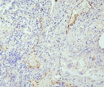IHC staining of FFPE human lung cancer with eNOS antibody. HIER: boil tissue sections in pH6, 10mM citrate buffer, for 20 min and allow to cool before testing.