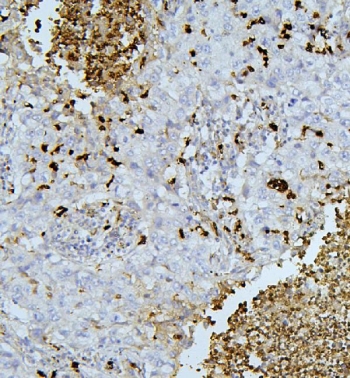 IHC staining of FFPE human lung cancer tissue with PEF1 antibody. HIER: boil tissue sections in pH8 EDTA for 20 min and allow to cool before testing.