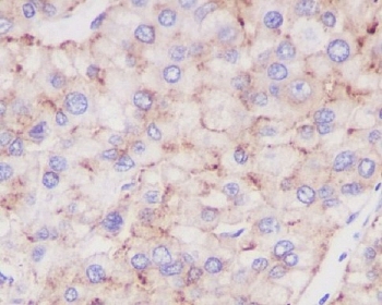 IHC staining of FFPE human liver cancer with LAMP-2A antibody. HIER: boil tissue sections in pH6, 10mM citrate buffer, for 10-20 min and allow to cool before testing.