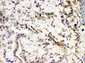 IHC staining of FFPE human liver cancer with APOL1 antibody. HIER: boil tissue sections in pH6, 10mM citrate buffer, for 20 min and allow to cool before testing.
