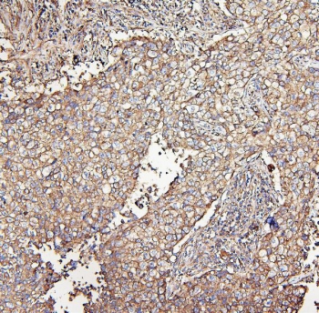 IHC staining of FFPE human lung cancer with MVP antibody. HIER: boil tissue sections in pH6, 10mM citrate buffer, for 20 min and allow to cool before testing.