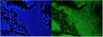 Immunofluorescent staining of FFPE human intestinal cancer with AUF1 antibody (green) and DAPI nuclear stain (blue). HIER: steam section in pH6 citrate buffer for 20 min.