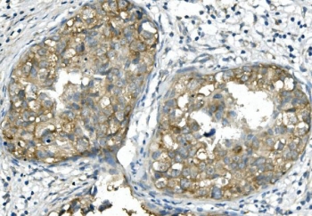 IHC staining of FFPE human breast cancer with BUB1B antibody. HIER: boil tissue sections in pH8 EDTA for 20 min and allow to cool before testing.