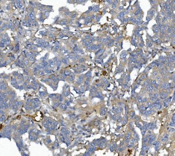 IHC staining of FFPE human ovarian cancer with Afamin antibody. HIER: boil tissue sections in pH8 EDTA for 20 min and allow to cool before testing.