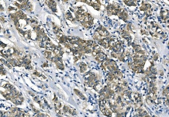 IHC staining of FFPE human breast cancer with ASS1 antibody. HIER: boil tissue sections in pH8 EDTA for 20 min and allow to cool before testing.