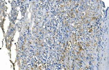 IHC staining of FFPE human gastric cancer with CA1 antibody. HIER: boil tissue sections in pH8 EDTA for 20 min and allow to cool before testing.