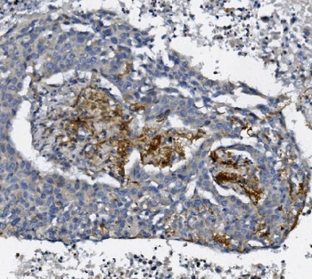 IHC staining of FFPE human lung cancer with AFAP1 antibody. HIER: boil tissue sections in pH8 EDTA for 20 min and allow to cool before testing.