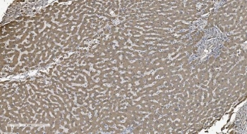 IHC staining of FFPE human liver cancer tissue with SHMT antibody. HIER: boil tissue sections in pH8 EDTA for 20 min and allow to cool before testing.