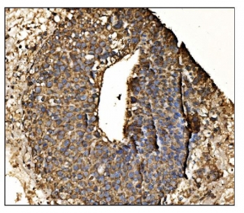IHC staining of FFPE human liver cancer tissue with Antizyme inhibitor 2 antibody. HIER: boil tissue sections in pH8 EDTA for 20 min and allow to cool before testing.