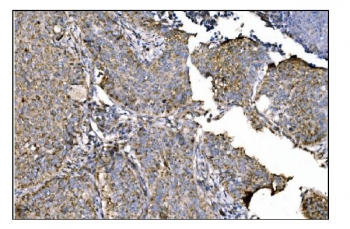 IHC staining of FFPE human lung cancer tissue with Ornithine Aminotransferase antibody. HIER: boil tissue sections in pH8 EDTA for 20 min and allow to cool before testing.