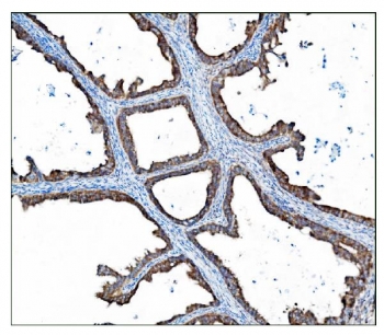 IHC staining of FFPE human ovarian cancer tissue with TBC1D4 antibody. HIER: boil tissue sections in pH8 EDTA for 20 min and allow to cool before testing.