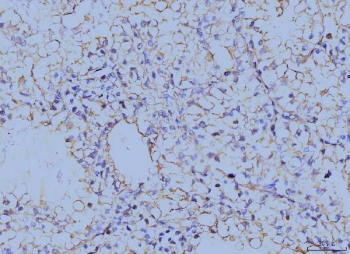 IHC staining of FFPE human renal clear cell carcinoma tissue with Annexin VI antibody. HIER: boil tissue sections in pH8 EDTA for 20 min and allow to cool before testing.