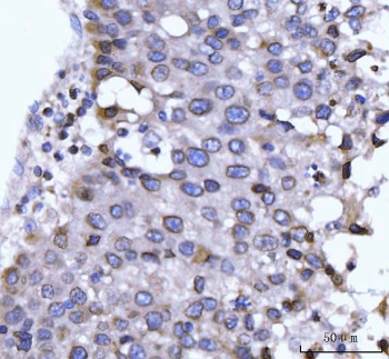 IHC staining of FFPE human liver tissue with NUP210 antibody. HIER: boil tissue sections in pH8 EDTA for 20 min and allow to cool before testing.