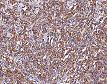 IHC staining of FFPE human lymphoma tissue with ENO1 antibody. HIER: boil tissue sections in pH8 EDTA for 20 min and allow to cool before testing.