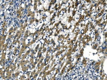 IHC staining of FFPE human liver cancer tissue with APLN antibody. HIER: boil tissue sections in pH8 EDTA for 20 min and allow to cool before testing.