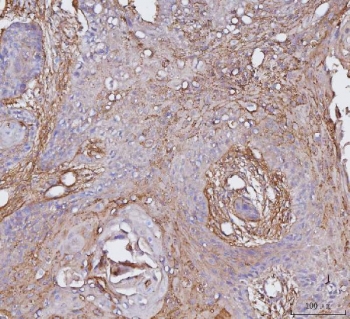 IHC staining of FFPE human esophageal squamous carcinoma tissue with CD51 antibody. HIER: boil tissue sections in pH8 EDTA for 20 min and allow to cool before testing.