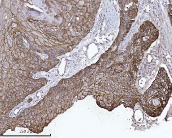 IHC staining of FFPE human laryngeal squamous cell carcinoma tissue with Catenin delta 1 antibody. HIER: boil tissue sections in pH8 EDTA for 20 min and allow to cool before testing.