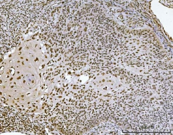 IHC staining of FFPE human laryngeal squamous cell carcinoma tissue with Ataxin 1 antibody. HIER: boil tissue sections in pH8 EDTA for 20 min and allow to cool before testing.