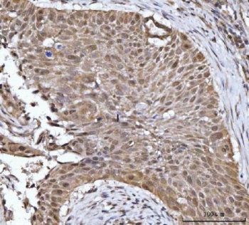IHC staining of FFPE human esophageal squamous carcinoma tissue with YWHAG antibody. HIER: boil tissue sections in pH8 EDTA for 20 min and allow to cool before testing.
