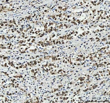 IHC staining of FFPE human hepatocellular carcinoma tissue with PC4 antibody. HIER: boil tissue sections in pH8 EDTA for 20 min and allow to cool before testing.
