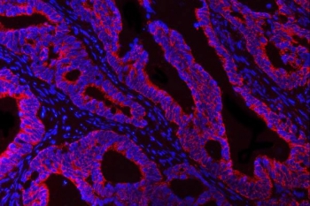 Immunofluorescent staining of FFPE human colorectal adenocarcinoma tissue with HBEGF antibody (red) and DAPI nuclear stain (blue). HIER: steam section in pH8 EDTA buffer for 20 min.