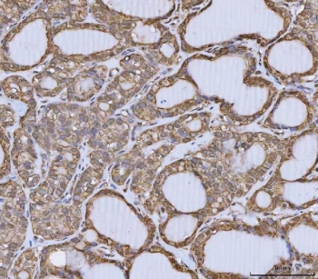 IHC staining of FFPE human thyroid cancer tissue with ANXA10 antibody. HIER: boil tissue sections in pH8 EDTA for 20 min and allow to cool before testing.