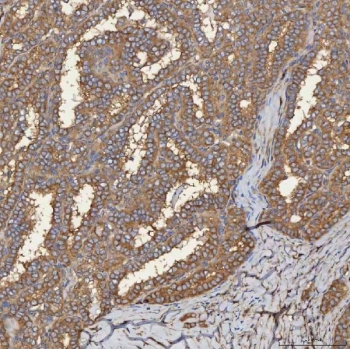 IHC staining of FFPE human thyroid cancer tissue with SEC31A antibody. HIER: boil tissue sections in pH8 EDTA for 20 min and allow to cool before testing.