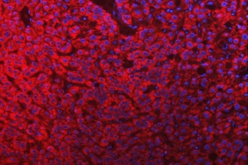 Immunofluorescent staining of FFPE human liver cancer tissue with SLC25A10 antibody (red) and DAPI nuclear stain (blue). HIER: steam section in pH6 citrate buffer for 20 min.