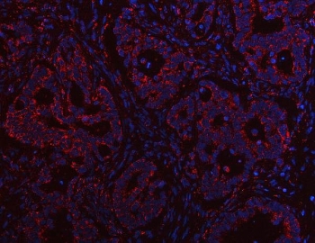 Immunofluorescent staining of FFPE human rectal cancer tissue with PTPIP51 antibody (red) and DAPI nuclear stain (blue). HIER: steam section in pH8 EDTA buffer for 20 min.