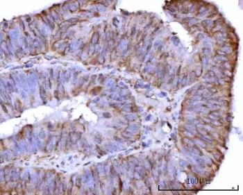 IHC staining of FFPE human colon adenocarcinoma tissue with RPS25 antibody. HIER: boil tissue sections in pH8 EDTA for 20 min and allow to cool before testing.