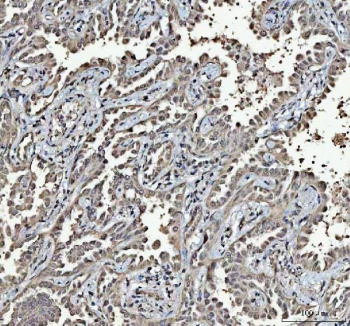 IHC staining of FFPE human lung cancer tissue with RTCB antibody. HIER: boil tissue sections in pH8 EDTA for 20 min and allow to cool before testing.