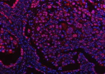 Immunofluorescent staining of FFPE human lung cancer tissue with Protein phosphatase 1G antibody (red) and DAPI nuclear stain (blue). HIER: steam section in pH8 EDTA buffer for 20 min.