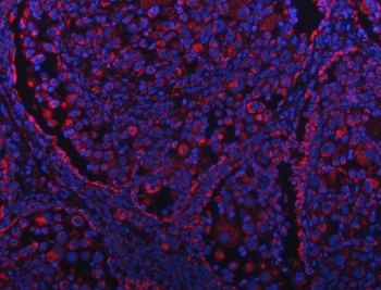 Immunofluorescent staining of FFPE human lung cancer tissue with GRIM19 antibody (red) and DAPI nuclear stain (blue). HIER: steam section in pH8 EDTA buffer for 20 min.