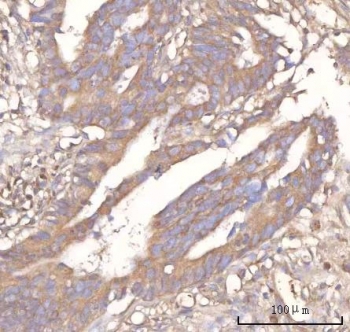 IHC staining of FFPE human rectum adenocarcinoma tissue with Neuralized-like protein 4 antibody. HIER: boil tissue sections in pH8 EDTA for 20 min and allow to cool before testing.