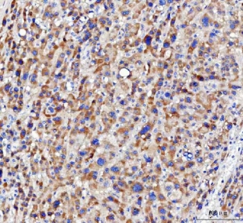 IHC staining of FFPE human liver cancer tissue with NUDT6 antibody. HIER: boil tissue sections in pH8 EDTA for 20 min and allow to cool before testing.
