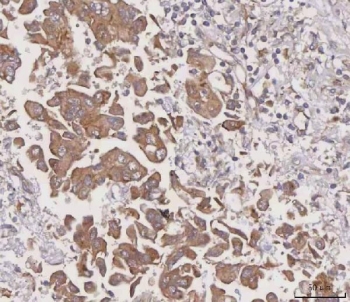IHC staining of FFPE human liver cancer tissue with MGAT3 antibody. HIER: boil tissue sections in pH8 EDTA for 20 min and allow to cool before testing.
