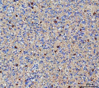 IHC staining of FFPE human glioma tissue with MGAT4B antibody. HIER: boil tissue sections in pH8 EDTA for 20 min and allow to cool before testing.