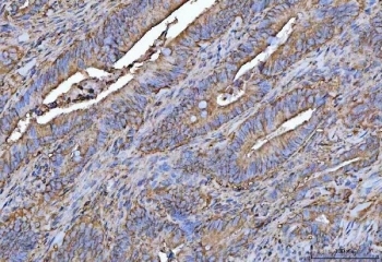 IHC staining of FFPE human colorectal adenocarcinoma tissue with PROSER3 antibody. HIER: boil tissue sections in pH8 EDTA for 20 min and allow to cool before testing.