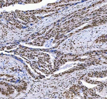 IHC staining of FFPE human colorectal adenocarcinoma tissue with Aryl Hydrocarbon Receptor Repressor antibody. HIER: boil tissue sections in pH8 EDTA for 20 min and allow to cool before testing.