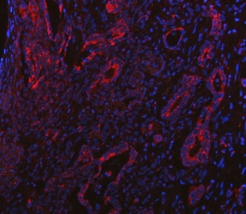 Immunofluorescent staining of FFPE human intestinal cancer tissue with PP18 antibody (red) and DAPI nuclear stain (blue). HIER: steam section in pH8 EDTA buffer for 20 min.
