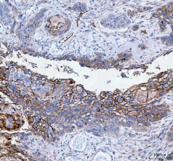 IHC staining of FFPE human esophageal squamous carcinoma tissue with Paralemmin antibody. HIER: boil tissue sections in pH8 EDTA for 20 min and allow to cool before testing.