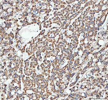 IHC staining of FFPE human liver cancer tissue with ATG7 antibody. HIER: boil tissue sections in pH8 EDTA for 20 min and allow to cool before testing.