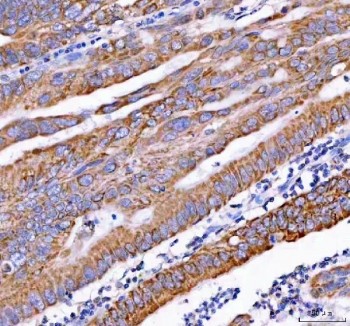 IHC staining of FFPE human rectum adenocarcinoma tissue with PDK3 antibody. HIER: boil tissue sections in pH8 EDTA for 20 min and allow to cool before testing.