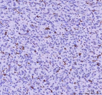 IHC staining of FFPE human glioma tissue with LPCAT2 antibody. HIER: boil tissue sections in pH8 EDTA for 20 min and allow to cool before testing.