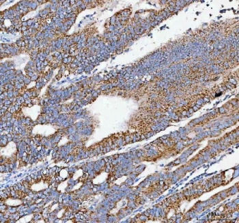 IHC staining of FFPE human rectum adenocarcinoma tissue with Pellino-3 antibody. HIER: boil tissue sections in pH8 EDTA for 20 min and allow to cool before testing.
