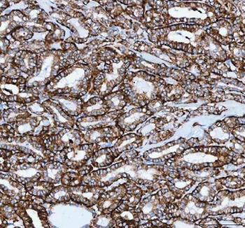 IHC staining of FFPE human thyroid papillary carcinoma tissue with Josephin 2 antibody. HIER: boil tissue sections in pH8 EDTA for 20 min and allow to cool before testing.